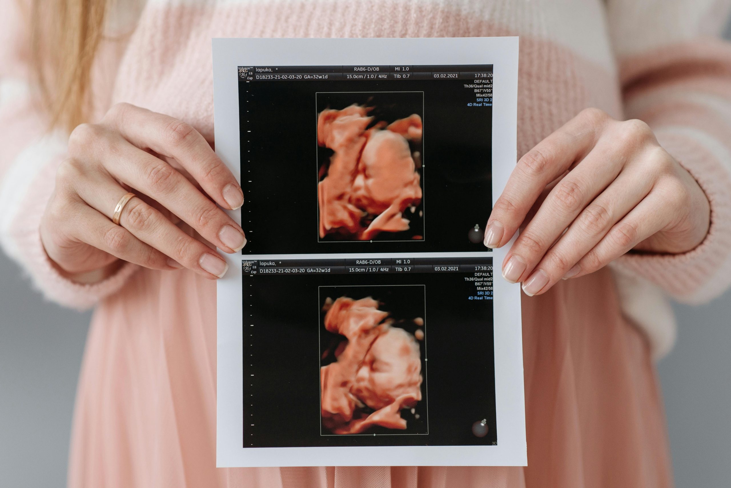 Panduan Scan Kehamilan: Apa yang Ibu Perlu Tahu